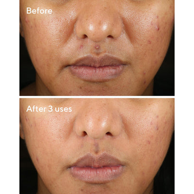 Murad Rapid Relief Acne Sulfur Mask Acne Treatments   